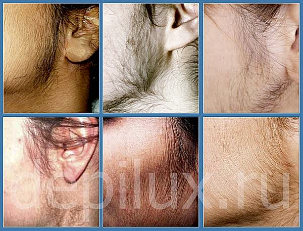 В таких случаях удалять бакенбарды имеет смысл