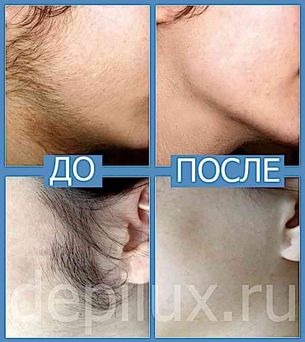 До и после удаления бакенбард