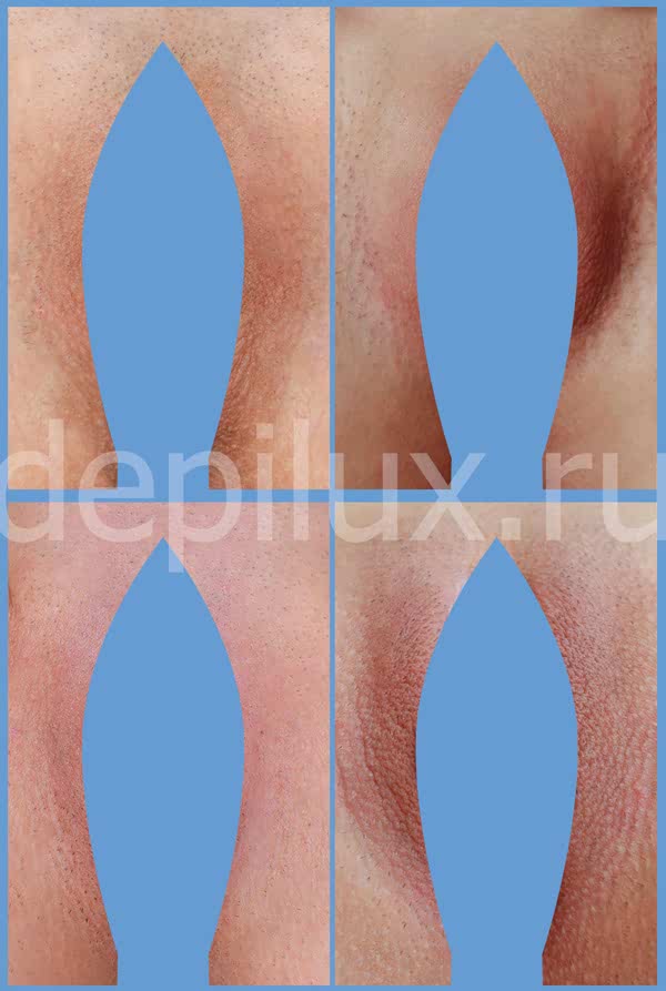 Фото результата бритья интимной зоны