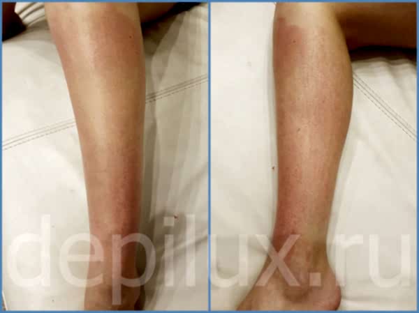 Раздражение после бритья волос на ногах