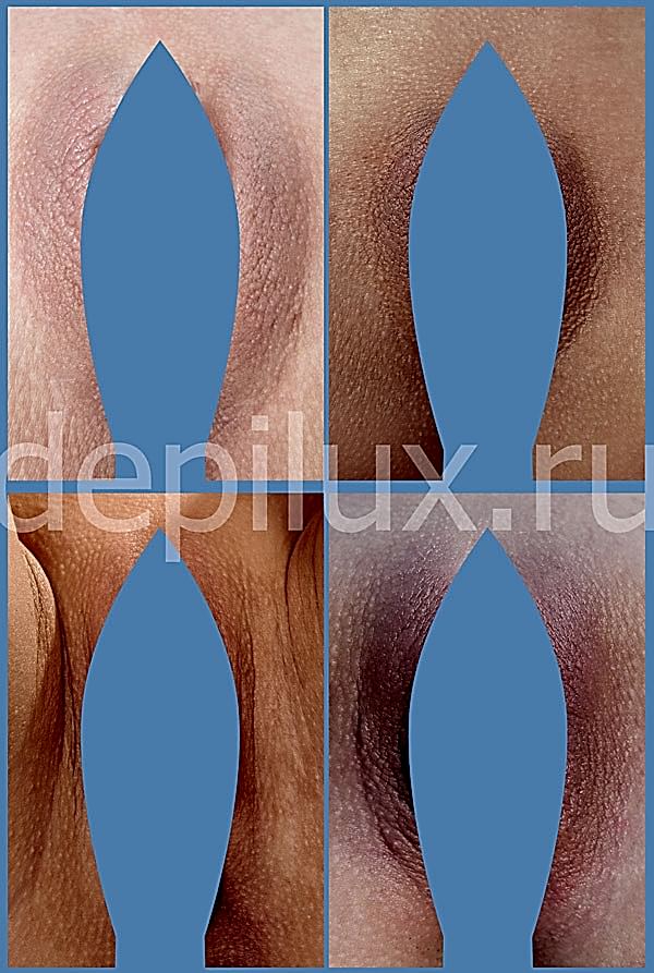 Фото результата депиляции зоны бикини