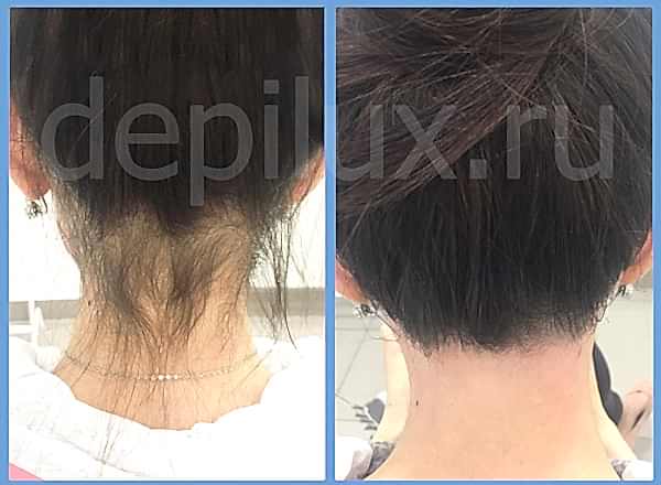 Депиляция шеи сзади - до и после процедуры