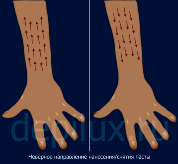 Неверное нанесение пасты при депиляции рук