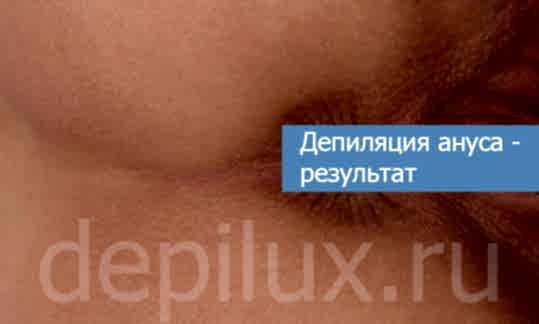 Депиляция ануса - результат