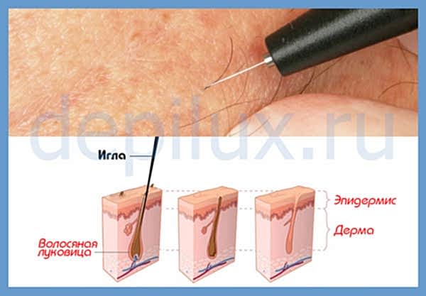 Электроэпиляция - принцип действия
