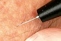 Электроэпиляция - все подробности