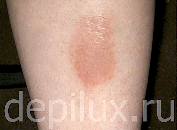 Последствия удаления волос марганцовкой