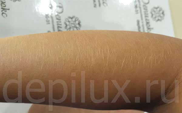 Результат удаления волос перекисью водорода